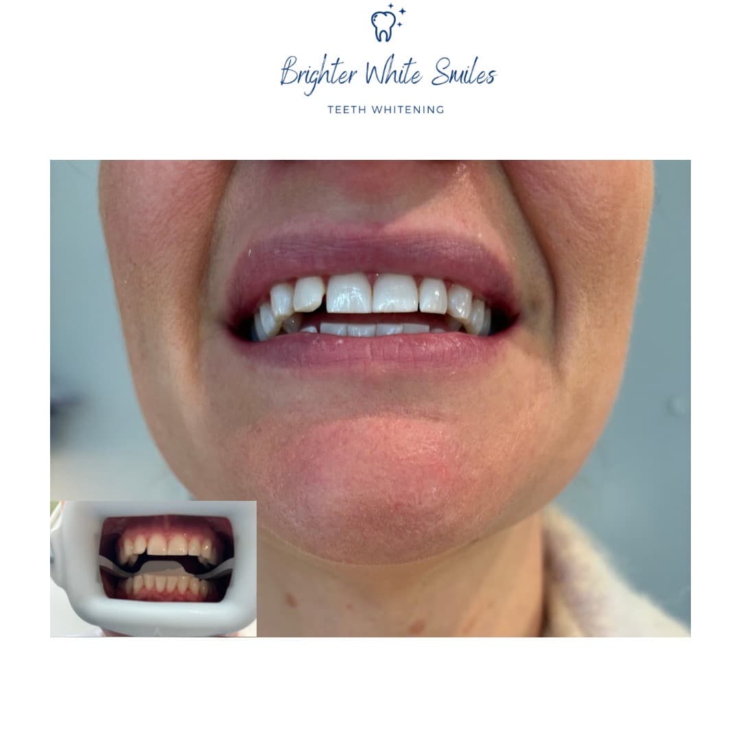A genuine Brighter White Smiles client result with a smaller before-treatment image inset