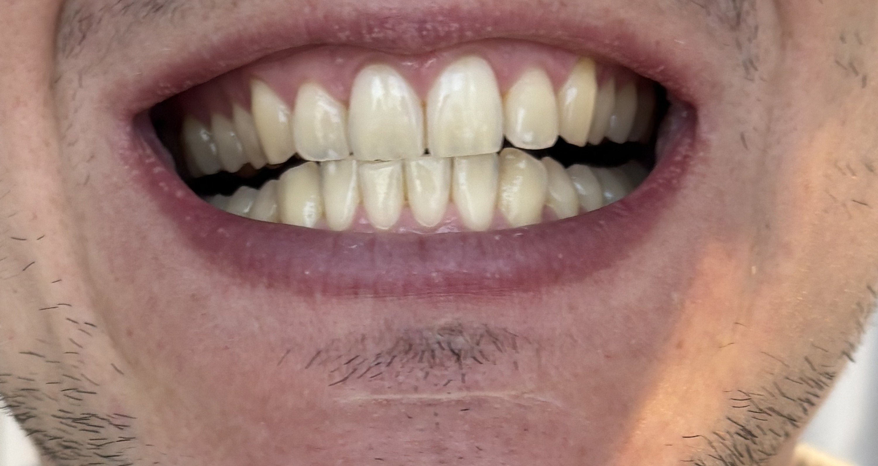 Before — Same-client professional teeth whitening transformation