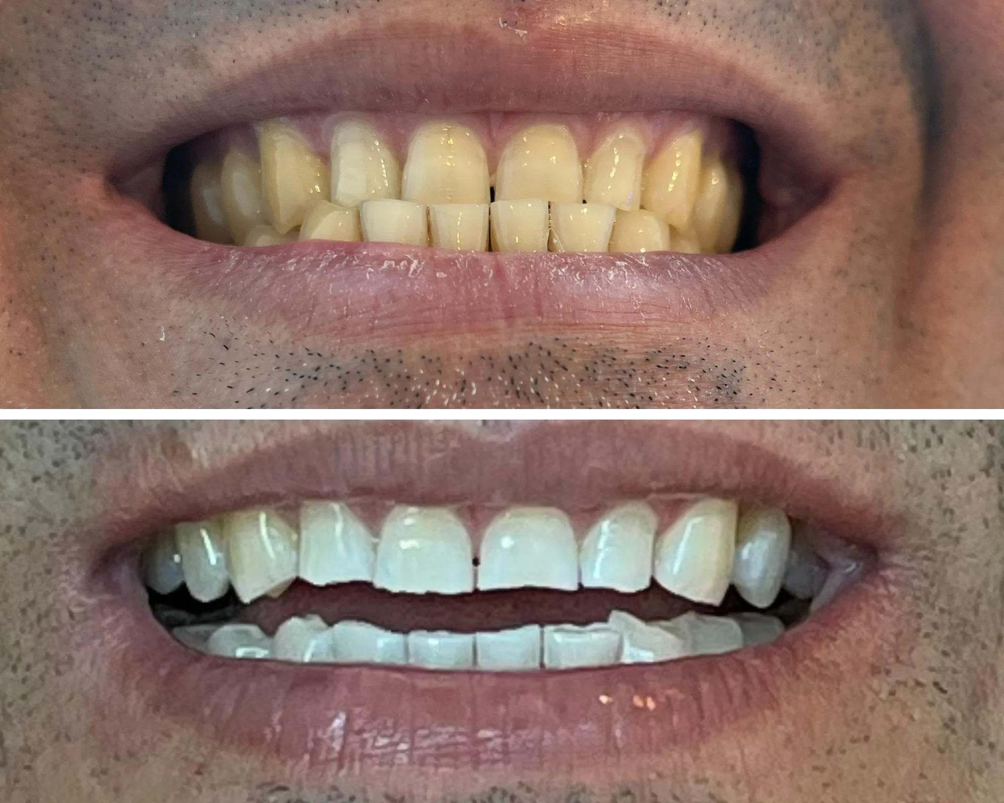 Teeth whitening result — before and after smile one
