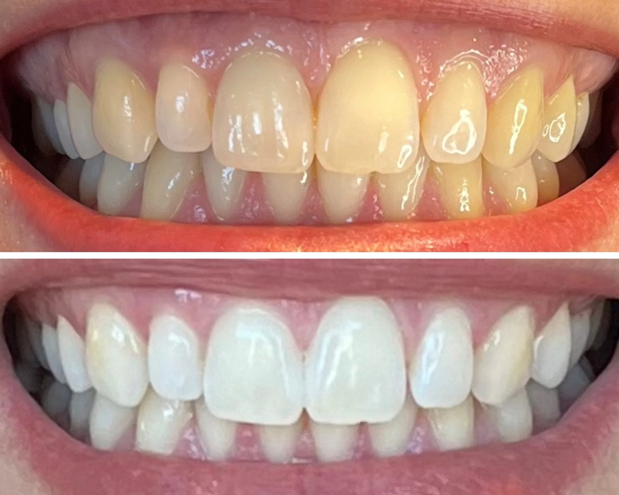 Teeth whitening result — before and after smile two