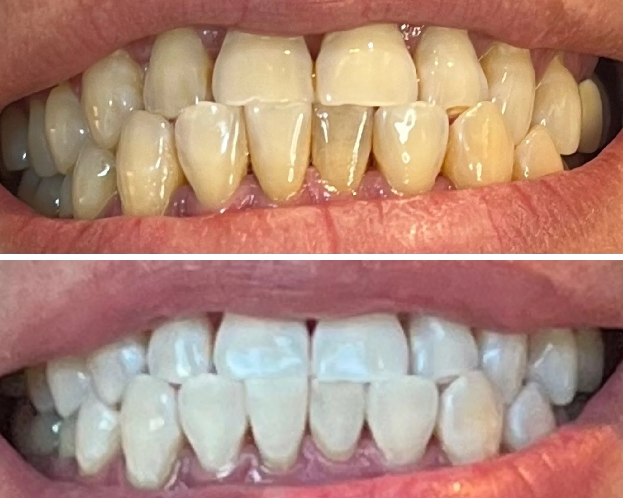 Teeth whitening result — before and after smile three