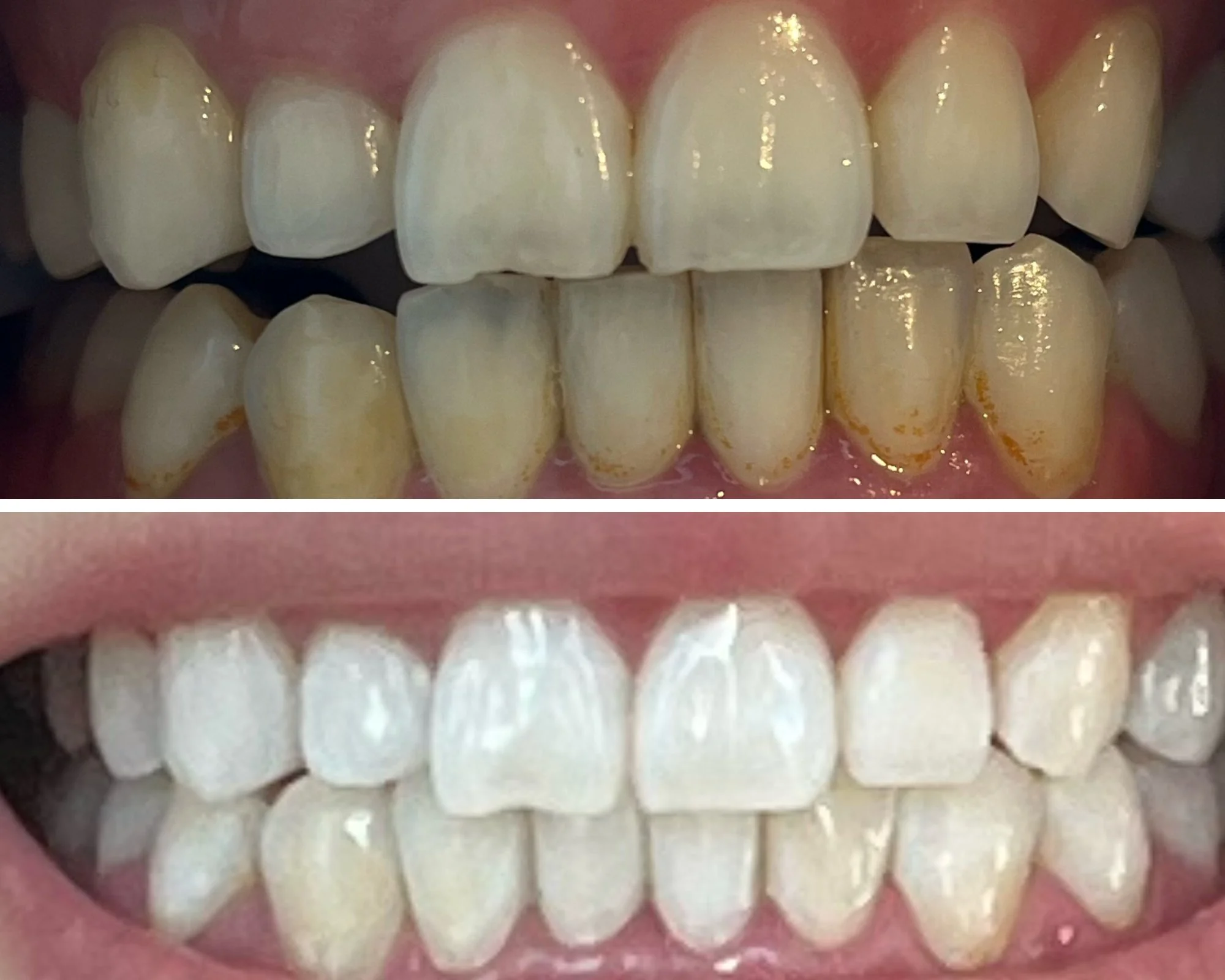 Teeth whitening result — before and after smile four