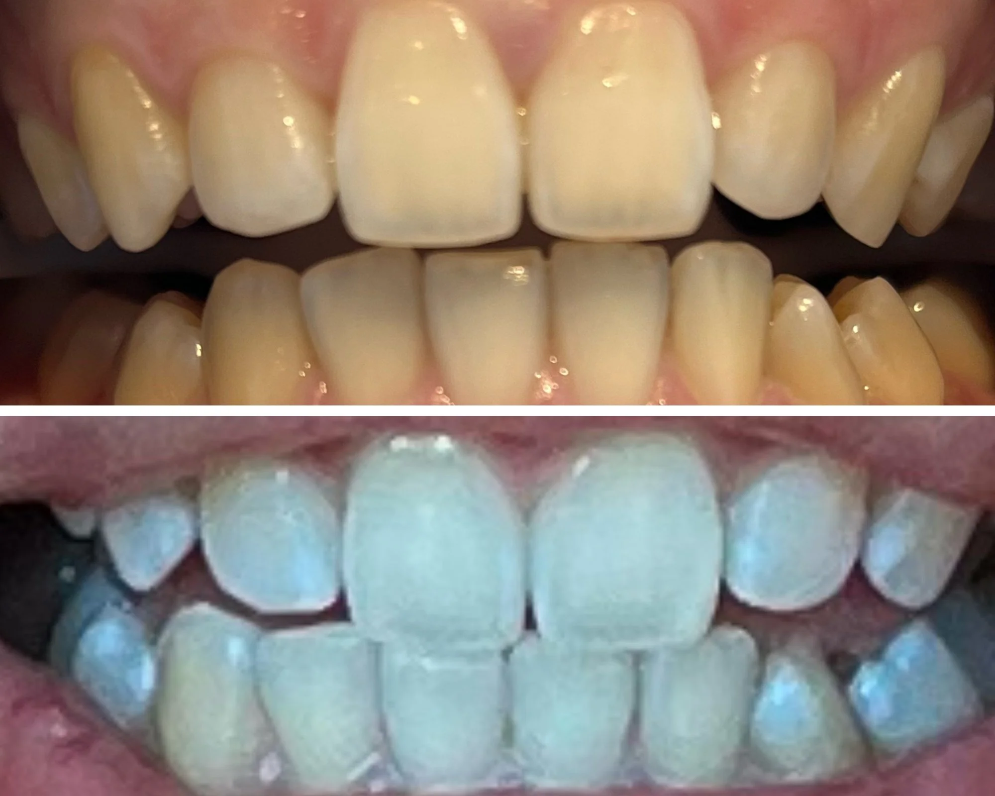 Teeth whitening result — before and after smile five