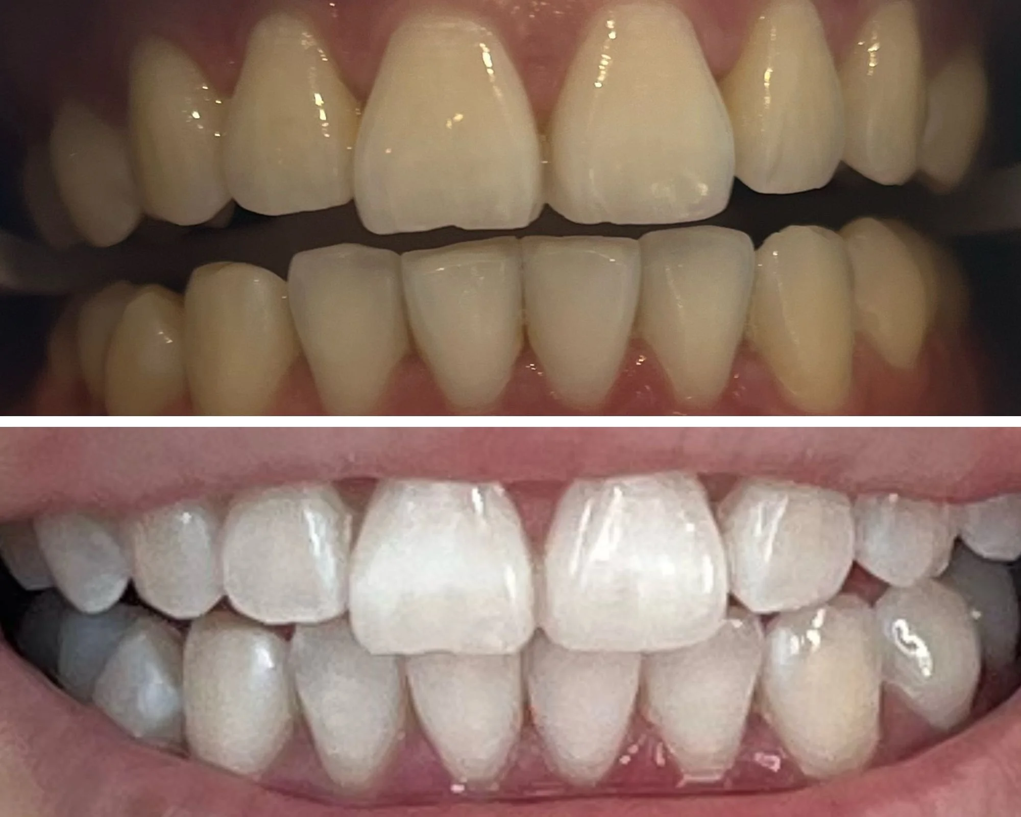 Teeth whitening result — before and after smile six